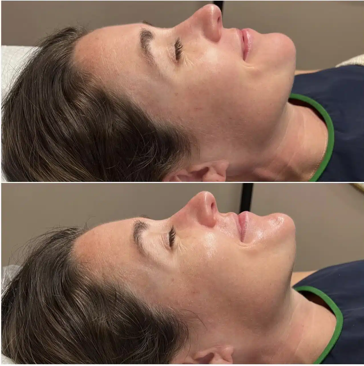 Cameo-BA-hydrafacial-a