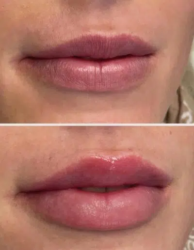 Cameo-BA-lip-fillers-a