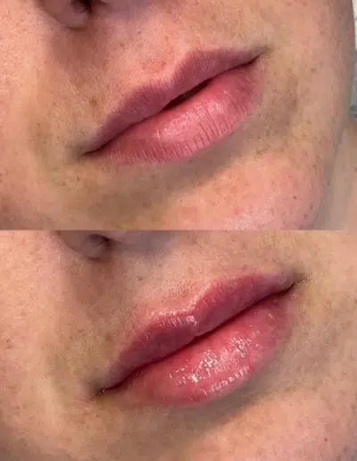 Cameo-BA-lip-fillers-b