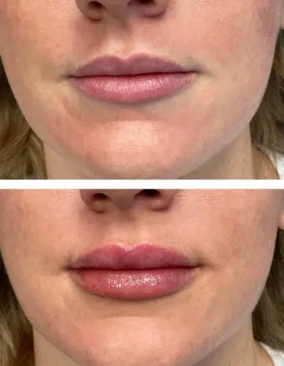 Cameo-BA-lip-fillers-c