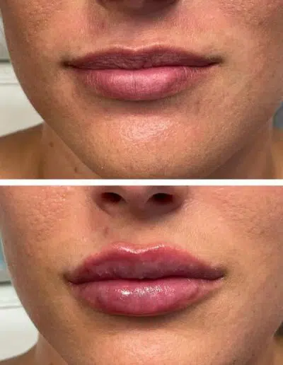 Cameo-BA-lip-fillers-d