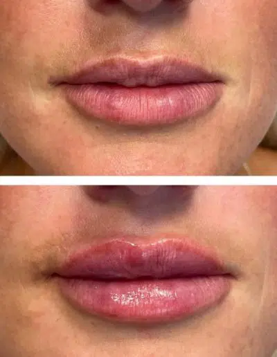 Cameo-BA-lip-fillers-e