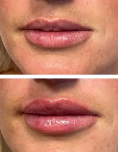 Cameo-BA-lip-fillers-f