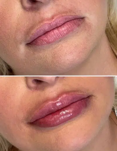 Cameo-BA-lip-fillers-g