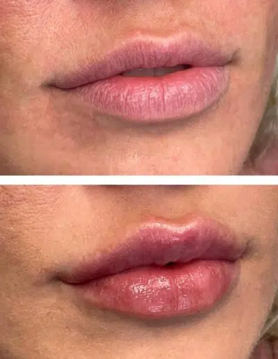 Cameo-BA-lip-fillers-h