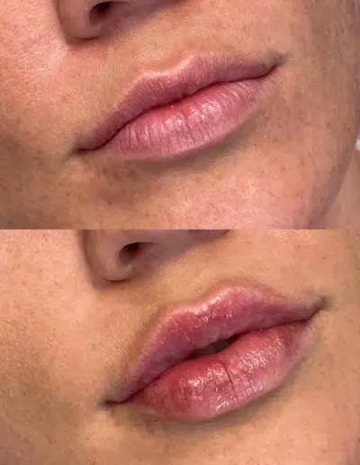 Cameo-BA-lip-fillers-i