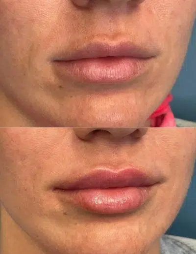 Cameo-BA-lip-fillers-j