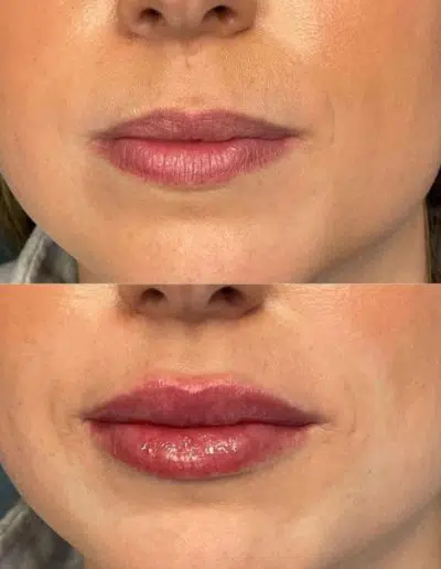 Cameo-BA-lip-fillers-k