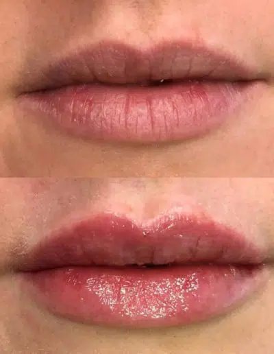 Cameo-BA-lip-fillers-l