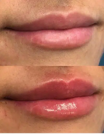 Cameo-BA-lip-fillers-m