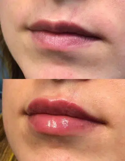 Cameo-BA-lip-fillers-n