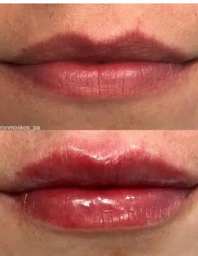 Cameo-BA-lip-fillers-o