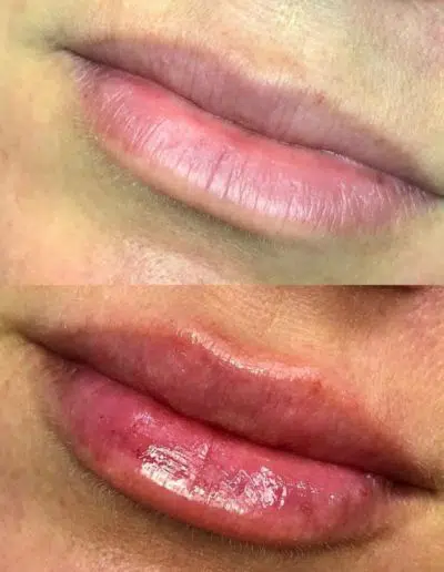 Cameo-BA-lip-fillers-p