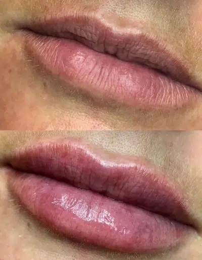 Cameo-BA-lip-fillers-q