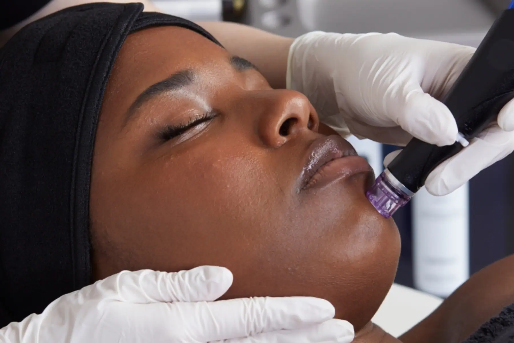 Hydrafacial in Mount Pleasant, SC