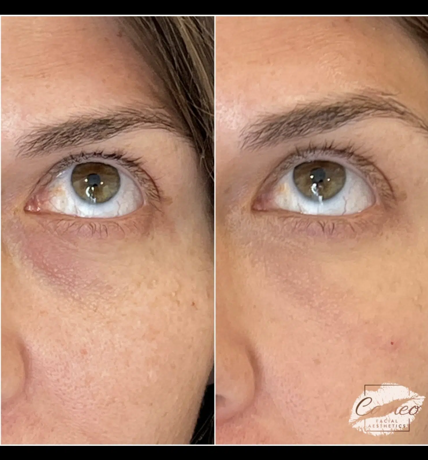 Brighten Your Eyes with Tear Trough Filler in Mount Pleasant, SC