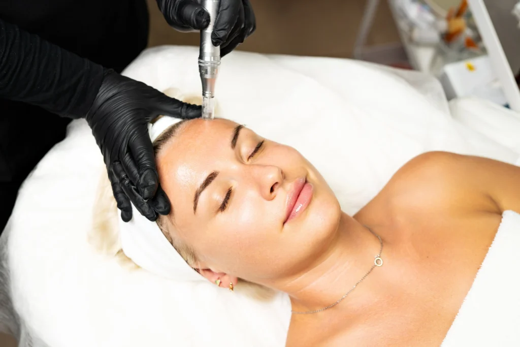 Microneedling in Mount Pleasant, SC | Cameo Facial Aesthetics